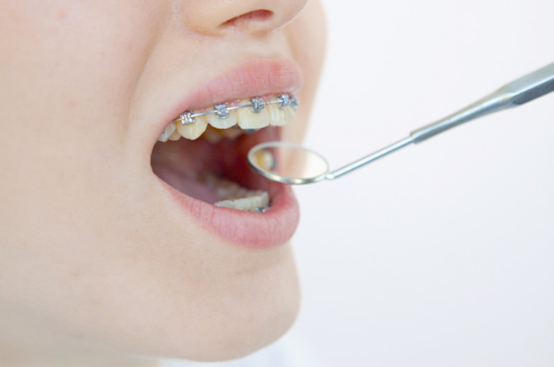 矯正歯科（小児矯正・成人矯正）