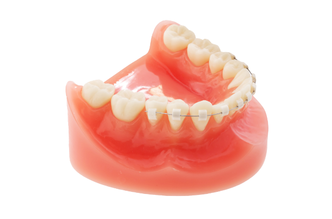 部分矯正（MTM）