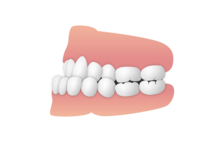 受け口（下顎前突）
