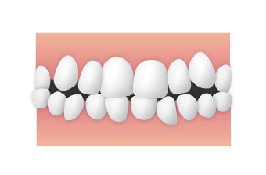歯並び_叢生