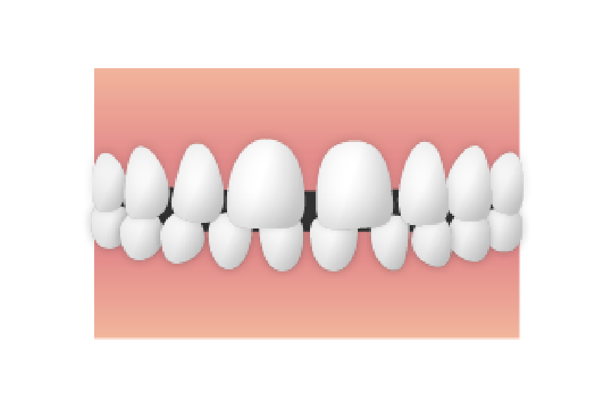 すきっ歯（空隙歯列）