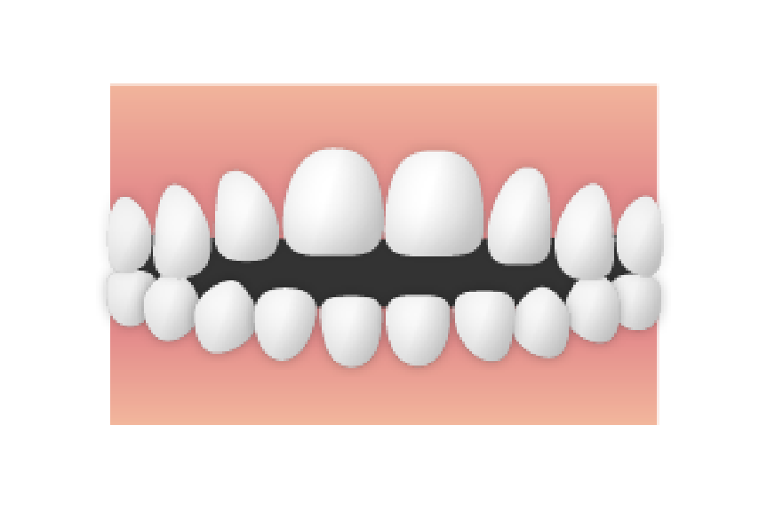 口が開いてしまう（開咬）