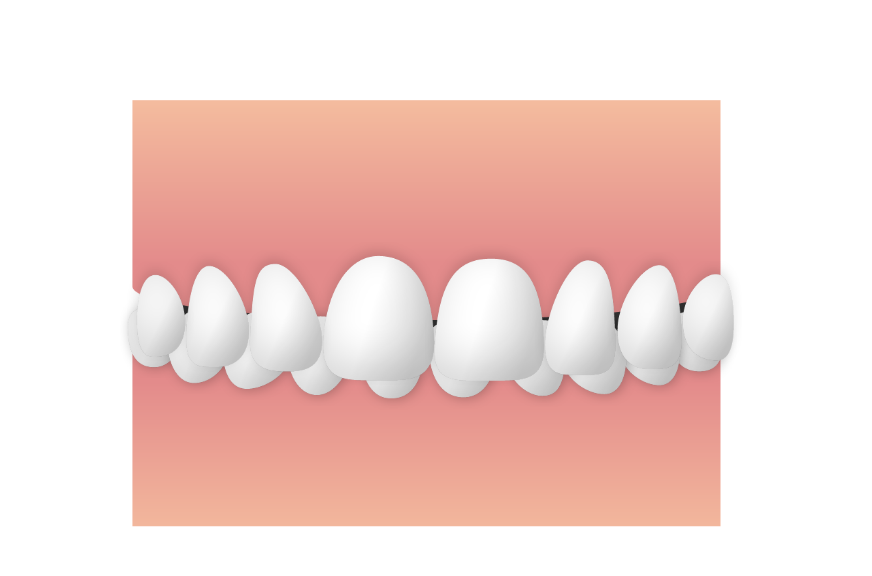 噛み合わせが深い（過蓋咬合）