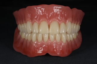 インプラントオーバーデンチャー