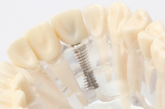 インプラントとは