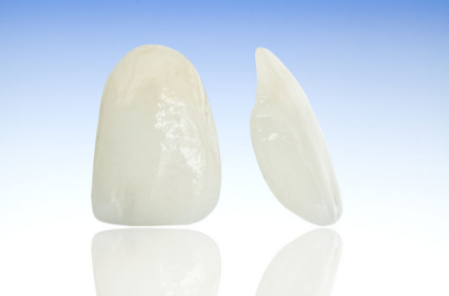 ラミネートべニア