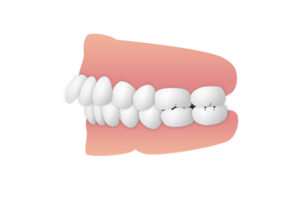 歯並び_出っ歯（上顎前突・下顎遠心咬合_）